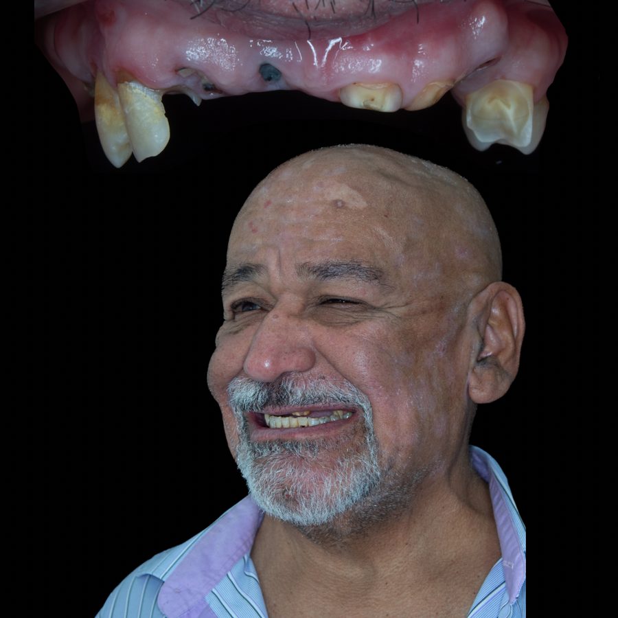 Antes de rehabilitación completa con implantes y coronas — caso 1 RL Orthodontics