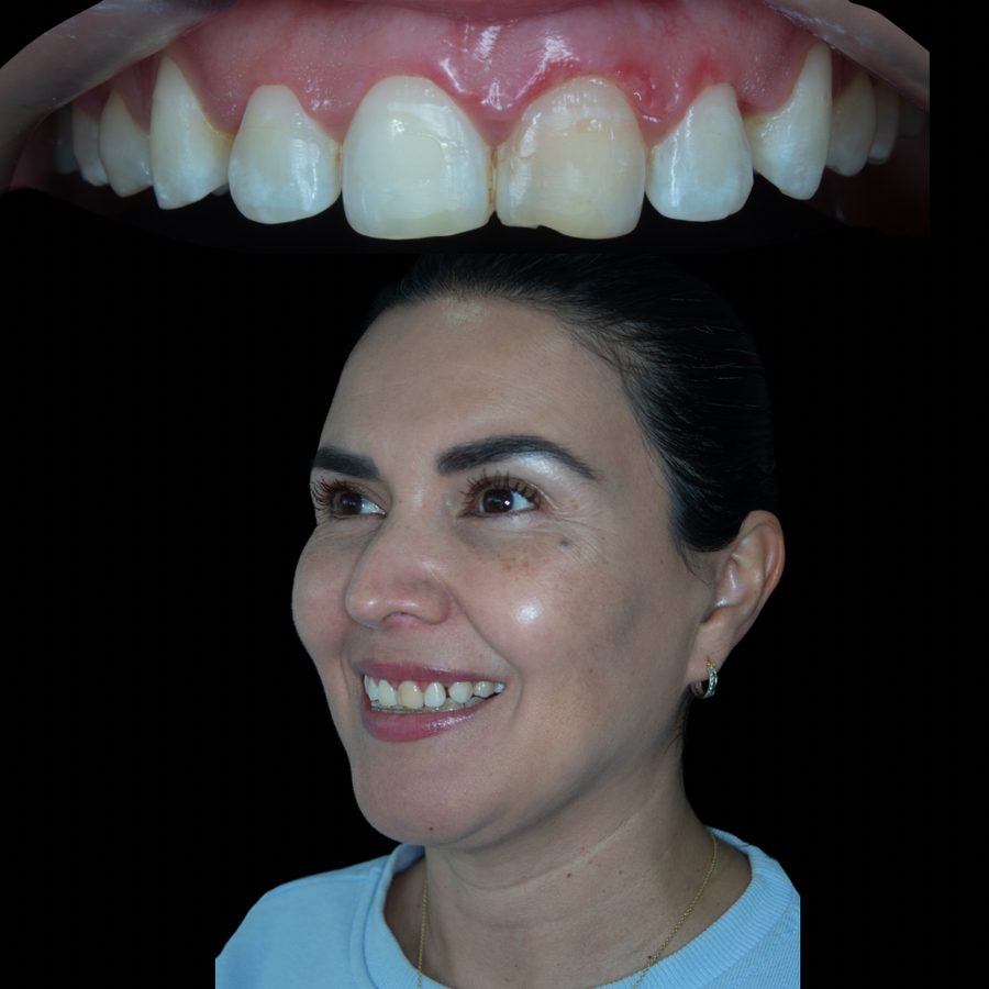 Antes de ortodoncia estética con carillas de resina — caso 2 RL Orthodontics