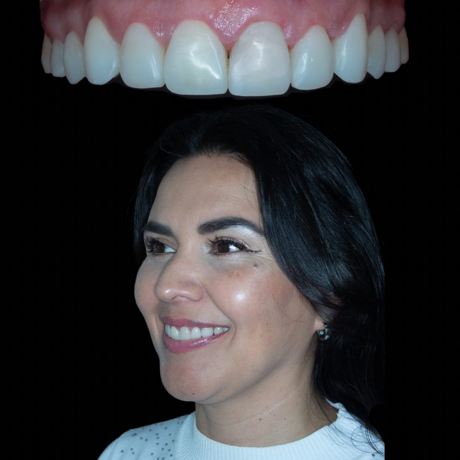Después de ortodoncia estética con carillas de resina — caso 2 RL Orthodontics