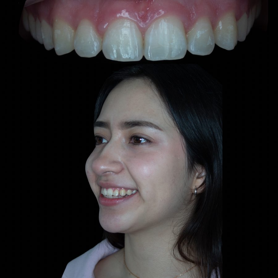 Antes de ortodoncia tradicional y diseño de sonrisa — caso 3 RL Orthodontics