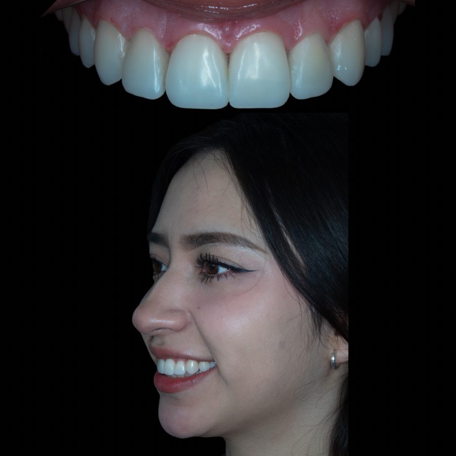 Después de ortodoncia tradicional y diseño de sonrisa — caso 3 RL Orthodontics