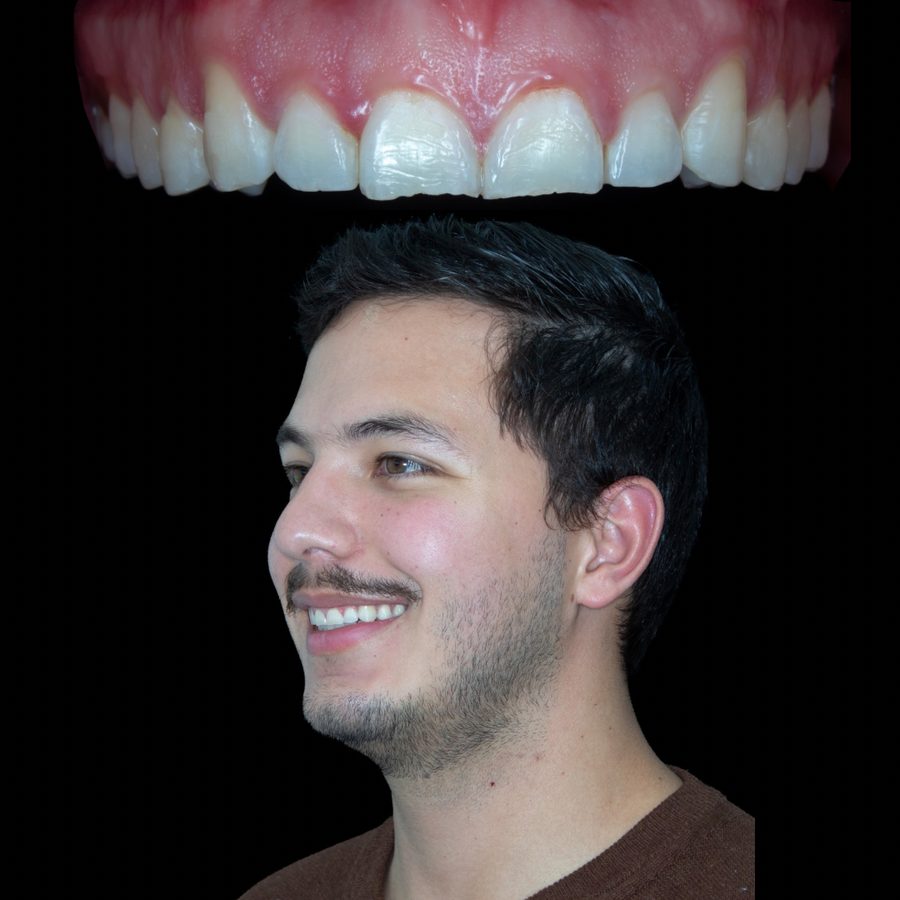 Antes de ortodoncia invisible y carillas de resina — caso 4 RL Orthodontics