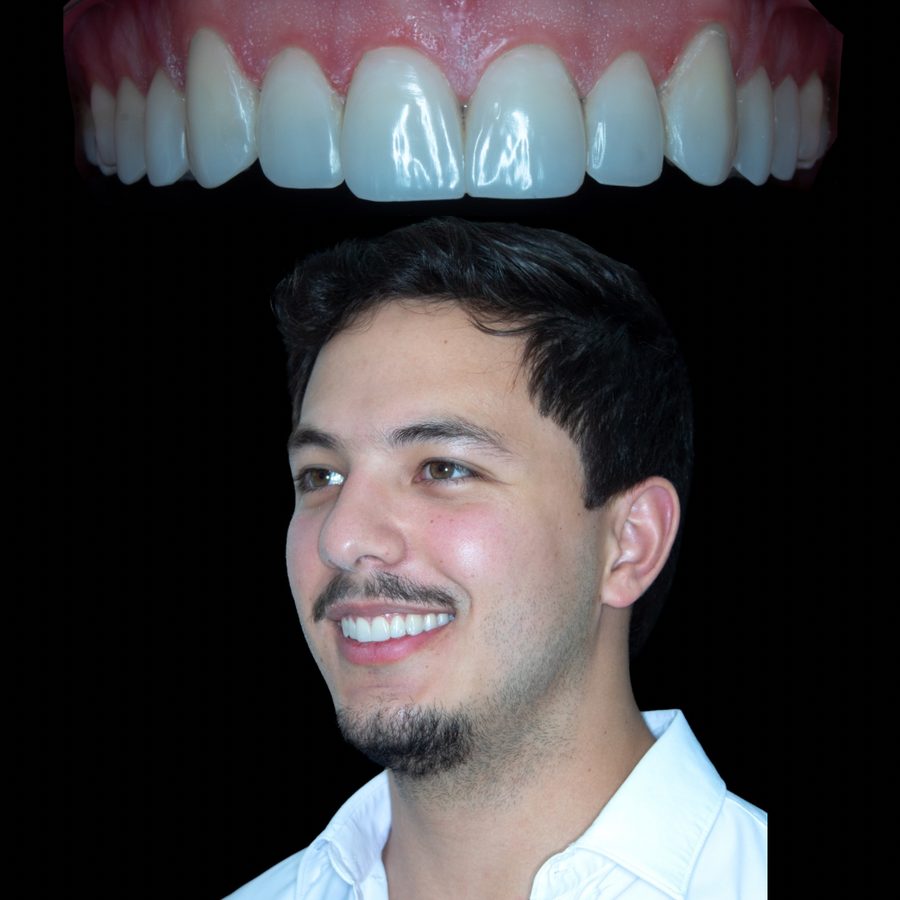 Después de ortodoncia invisible y carillas de resina — caso 4 RL Orthodontics